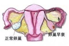 卵巢早衰